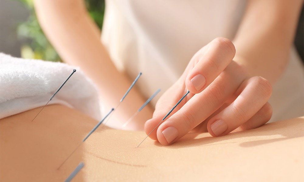 Descubre los beneficios de la acupuntura