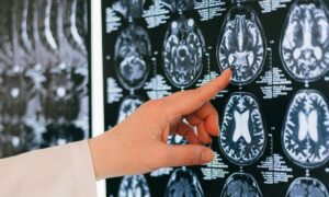 Descubre qué son las lesiones cerebrales y qué provocan